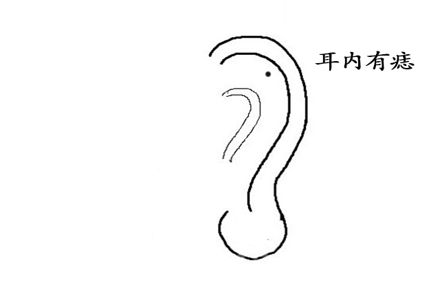 耳根有痣代表什么（耳根长痣好不好）-3