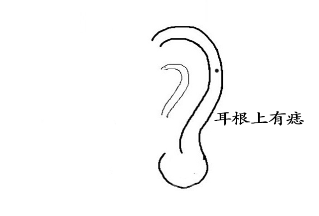 耳根有痣代表什么（耳根长痣好不好）-4