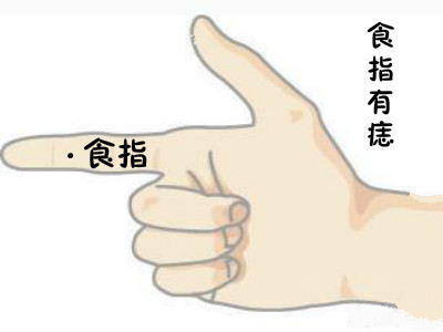 手指有痣代表什么意思（老人说手上长痣是遇到对的人）-3