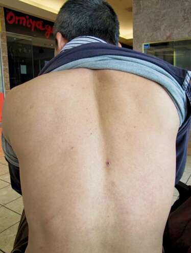 详细分析：男人背部痣相含义，你背上哪些部位有痣？